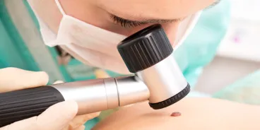Zákeřného melanomu každoročně přibývá, raketově rostou i náklady na léčbu